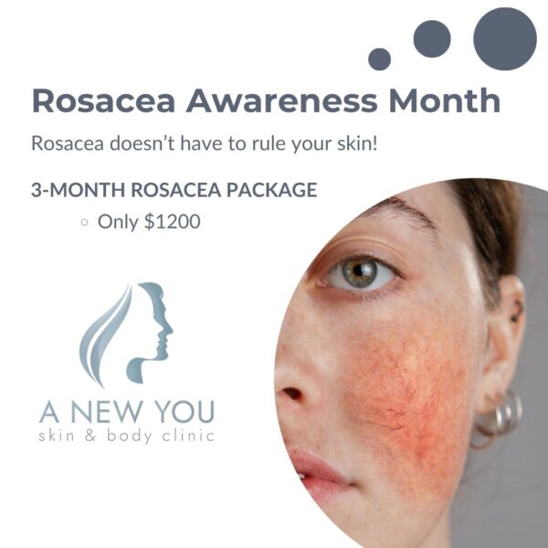 Rosacea (1)