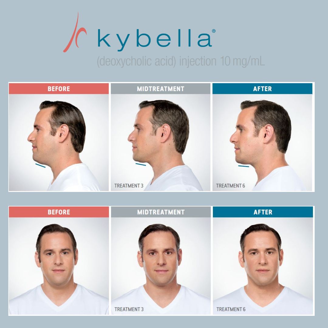 Kybella Before and After