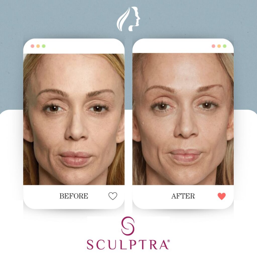 Sculptra Before and After