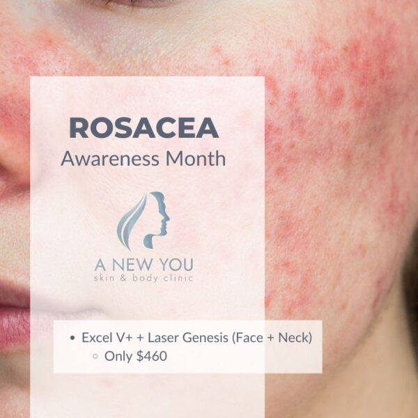 Rosacea